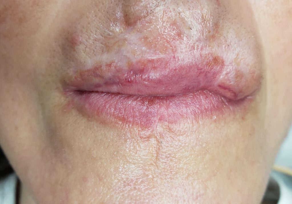 Caso Cliinico Micropigmentação labial - Eliane Guerra