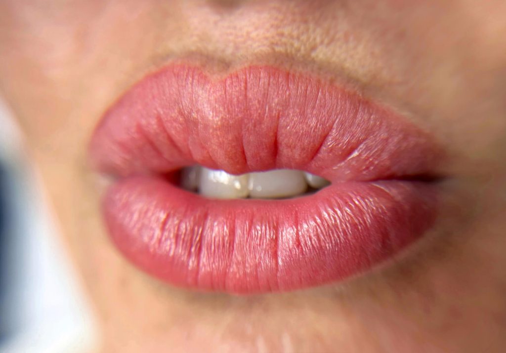 Revitalização Labial